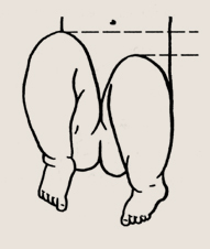 Разная длина ног у ребенка по уровню коленных суставов