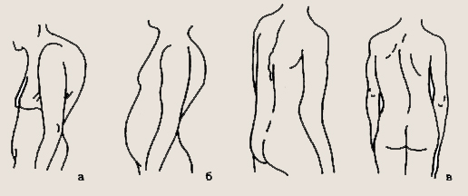 изменения формы спины