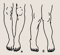 изменения формы ног